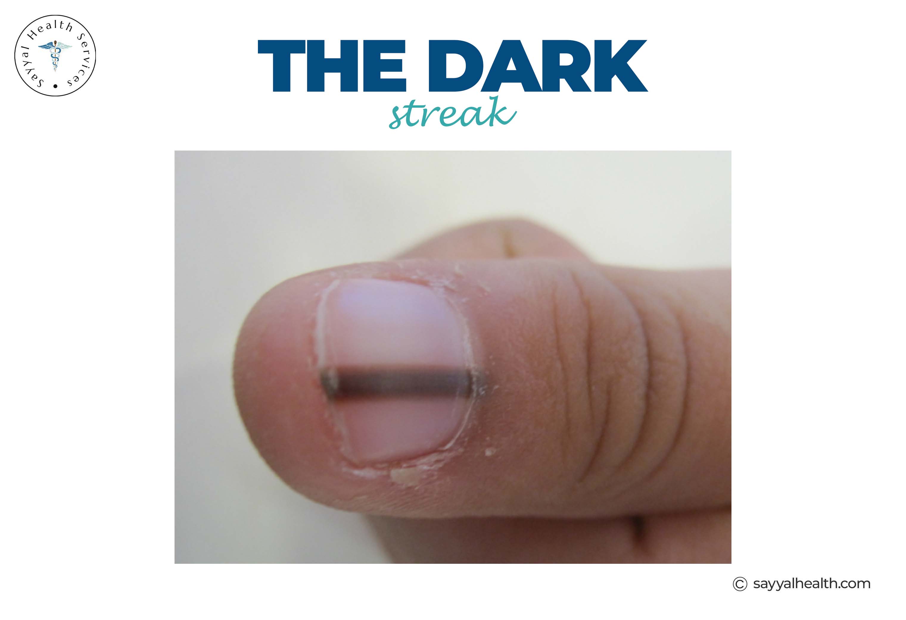 Dark streak on fingernail indicating potential melanoma